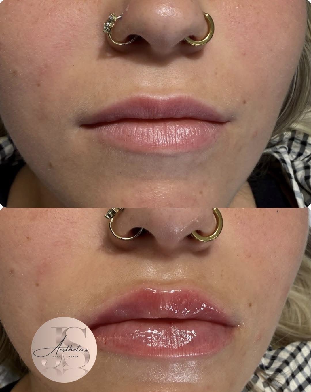 Lip filler at JS Aesthetics Beauty Lounge, Bangor