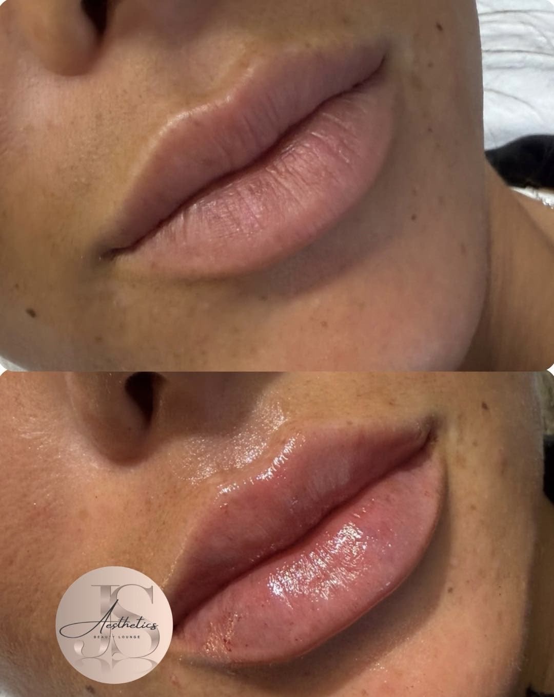 Lip filler at JS Aesthetics Beauty Lounge, Bangor