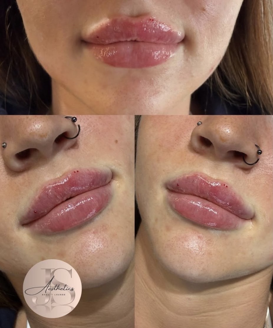 Lip filler at JS Aesthetics Beauty Lounge, Bangor