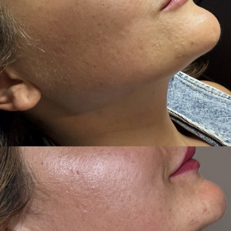 JS Aesthetics Beauty Lounge treatment result 3