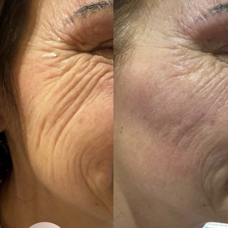 JS Aesthetics Beauty Lounge treatment result 4